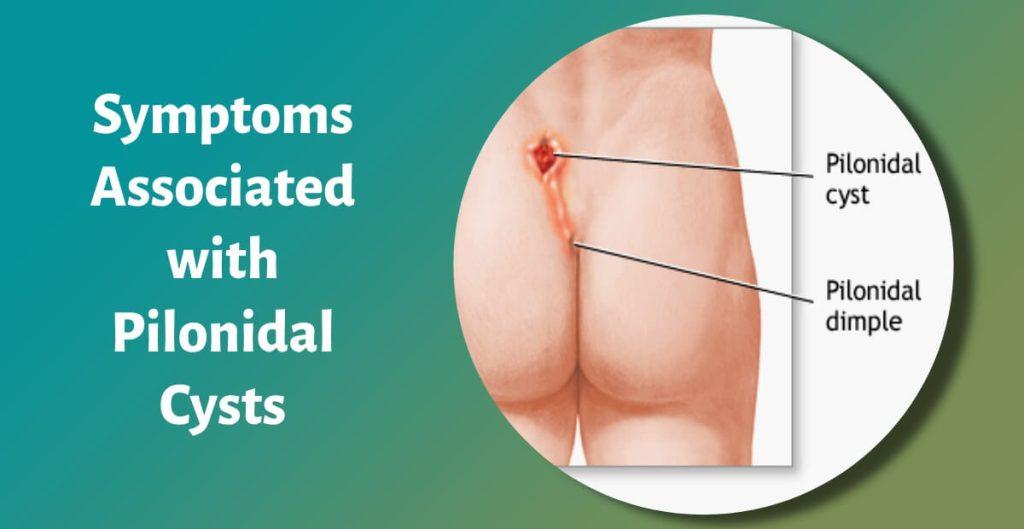 Symptoms Associated with Pilonidal Cysts
