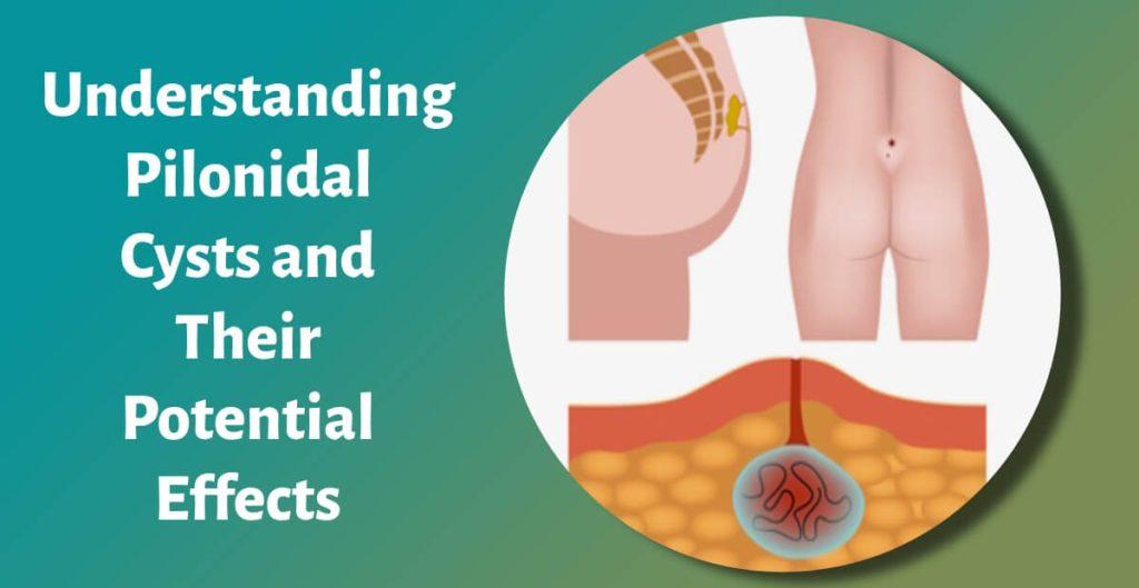 Understanding Pilonidal Cysts and Their Potential Effects