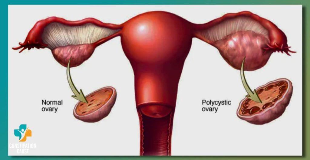 Polycystic Ovarian Syndrome and Constipation